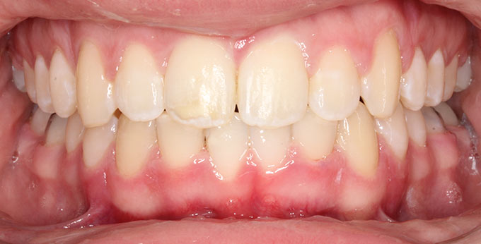 After treatment for severely retrusive lower jaw using a twin Block removable appliance
